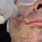 black_carbon_laser_peel_facial