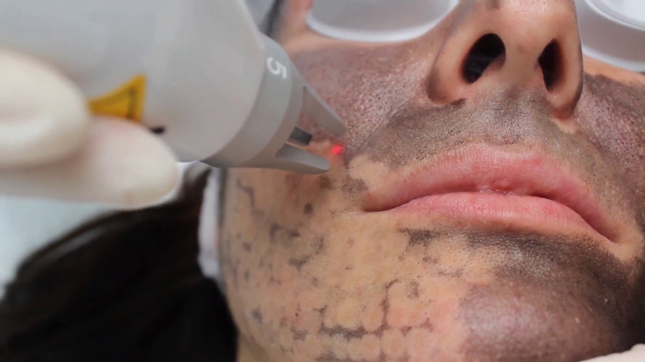 Advanced laser treatment at NDI Aesthetics in Kuils River Cape Town