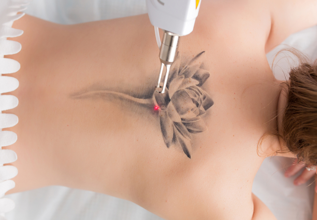 Laser tattoo removal treatment at NDI Aesthetics in Kuils River Cape Town