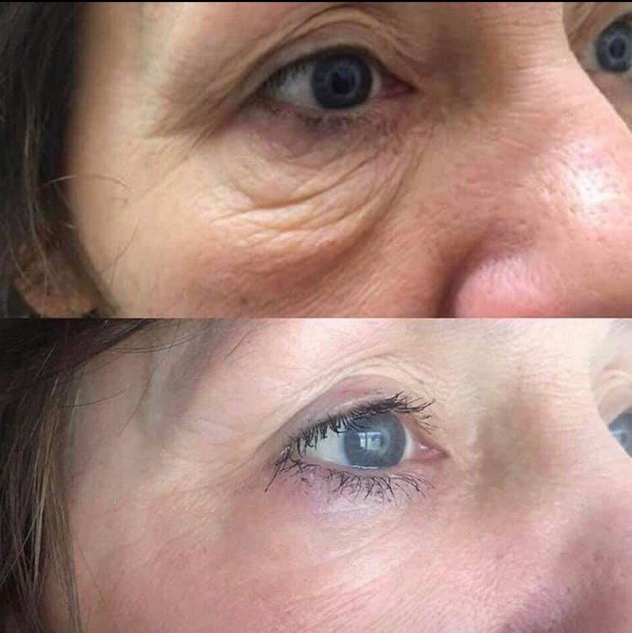 Plasma treatment for selected lower eyelid skin tightening