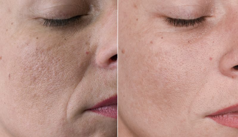 Targeted plasma skin tightening treatment for facial ageing