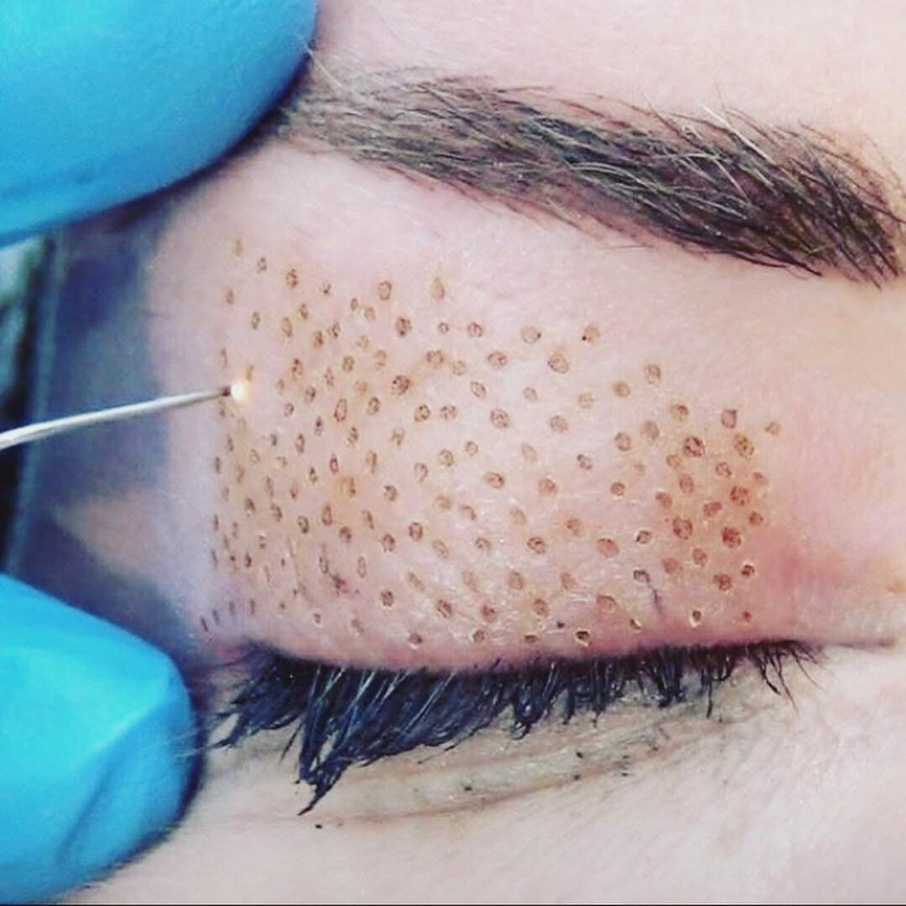 Plasma pen skin tightening treatment in Kuils River Cape Town