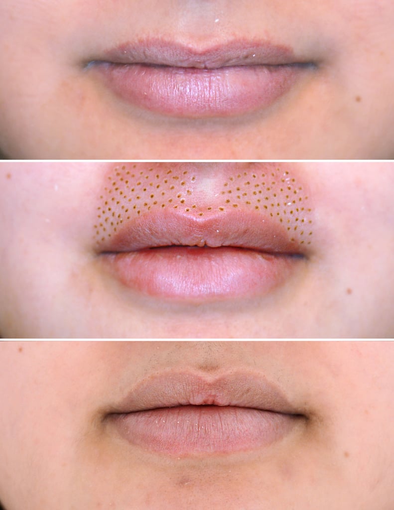 Skin treatment transformation before and after by NDI Aesthetics Kuils River