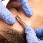 dermaplaning