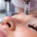 microneedling