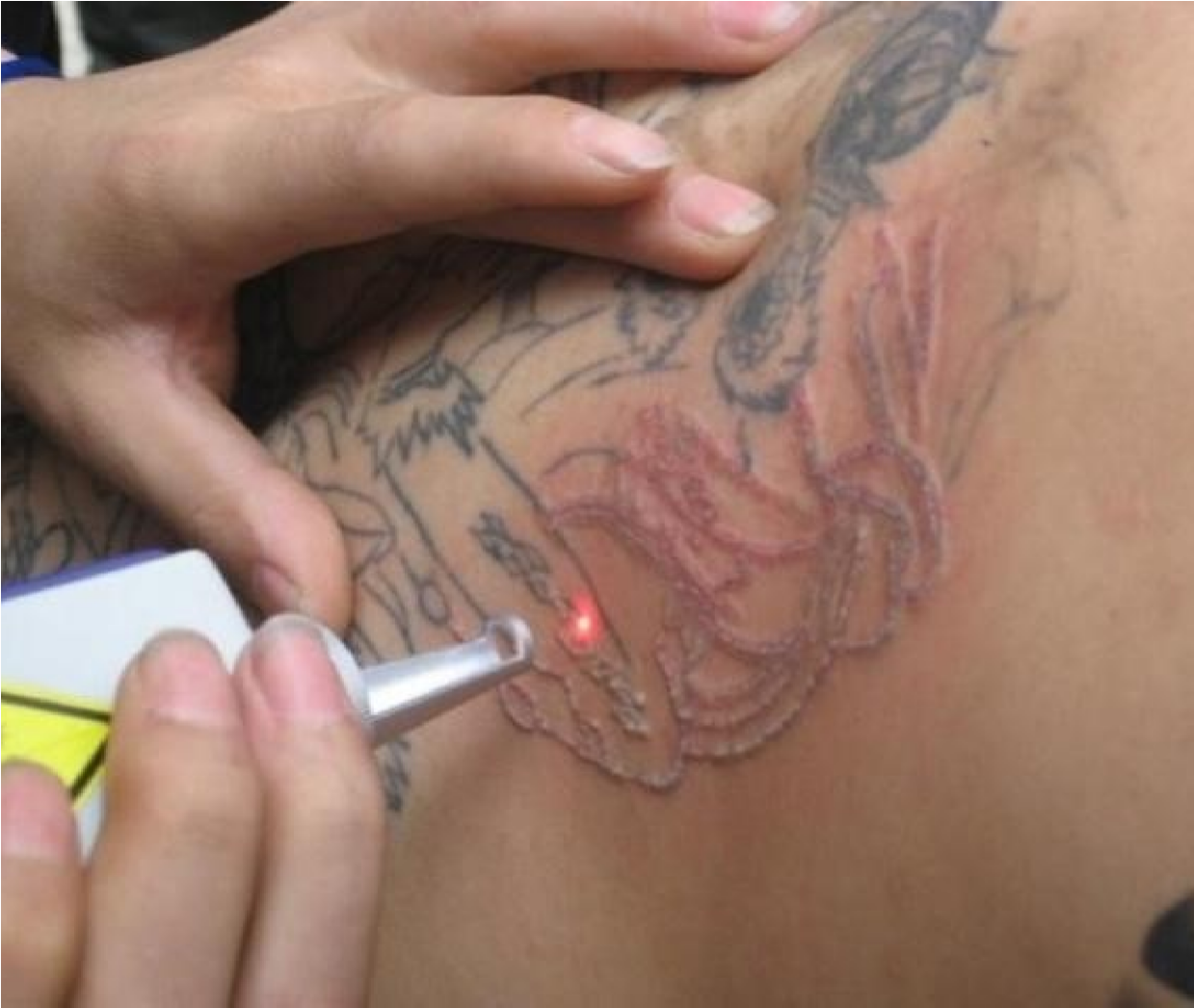 Laser tattoo pigment removal treatment at NDI Aesthetics