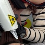 tattoo_removal_cape_town