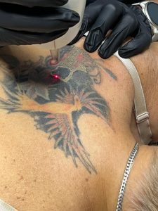 laser_tattoo_removal