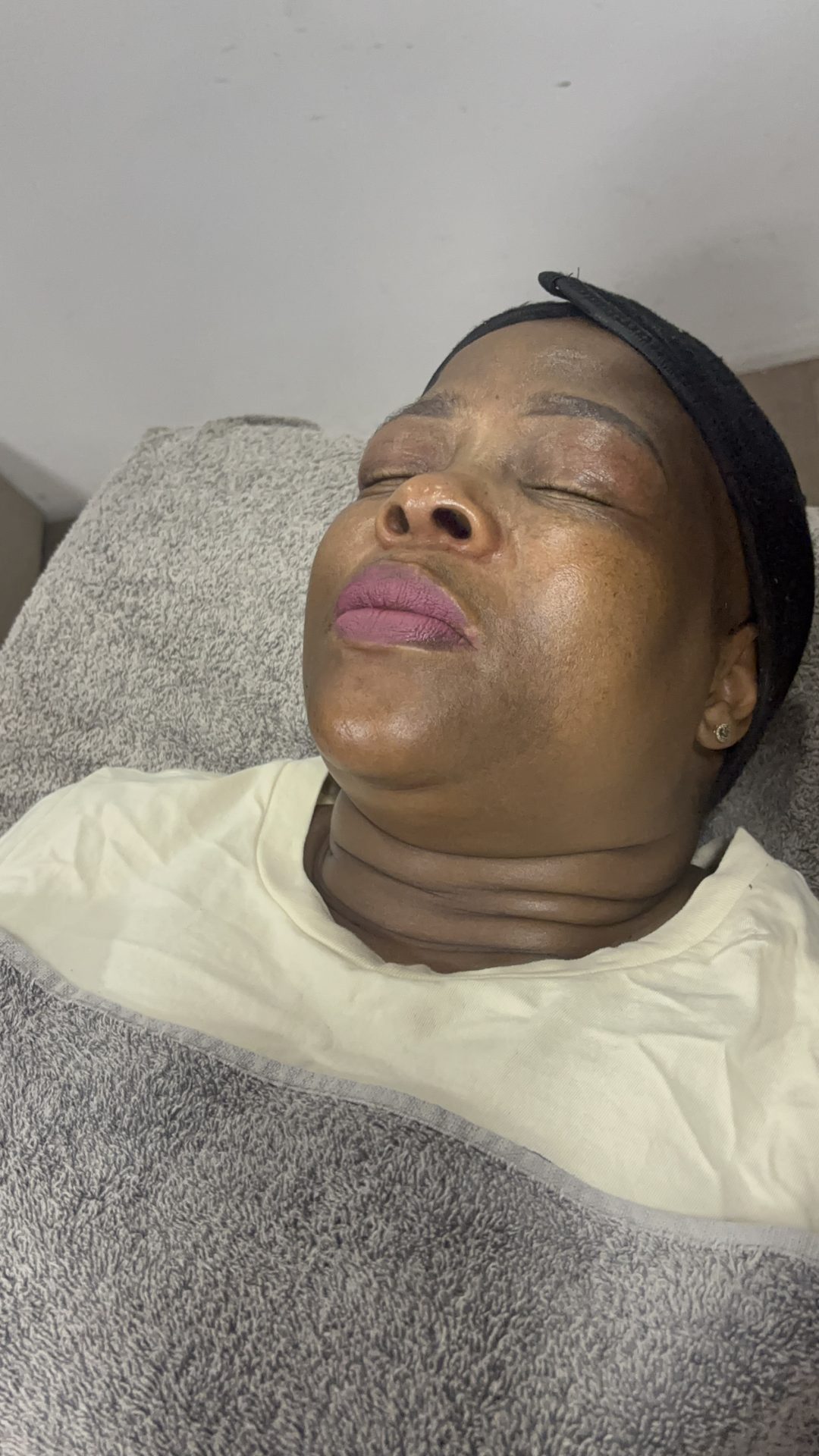 Skin treatment before result at NDI Aesthetics Kuils River