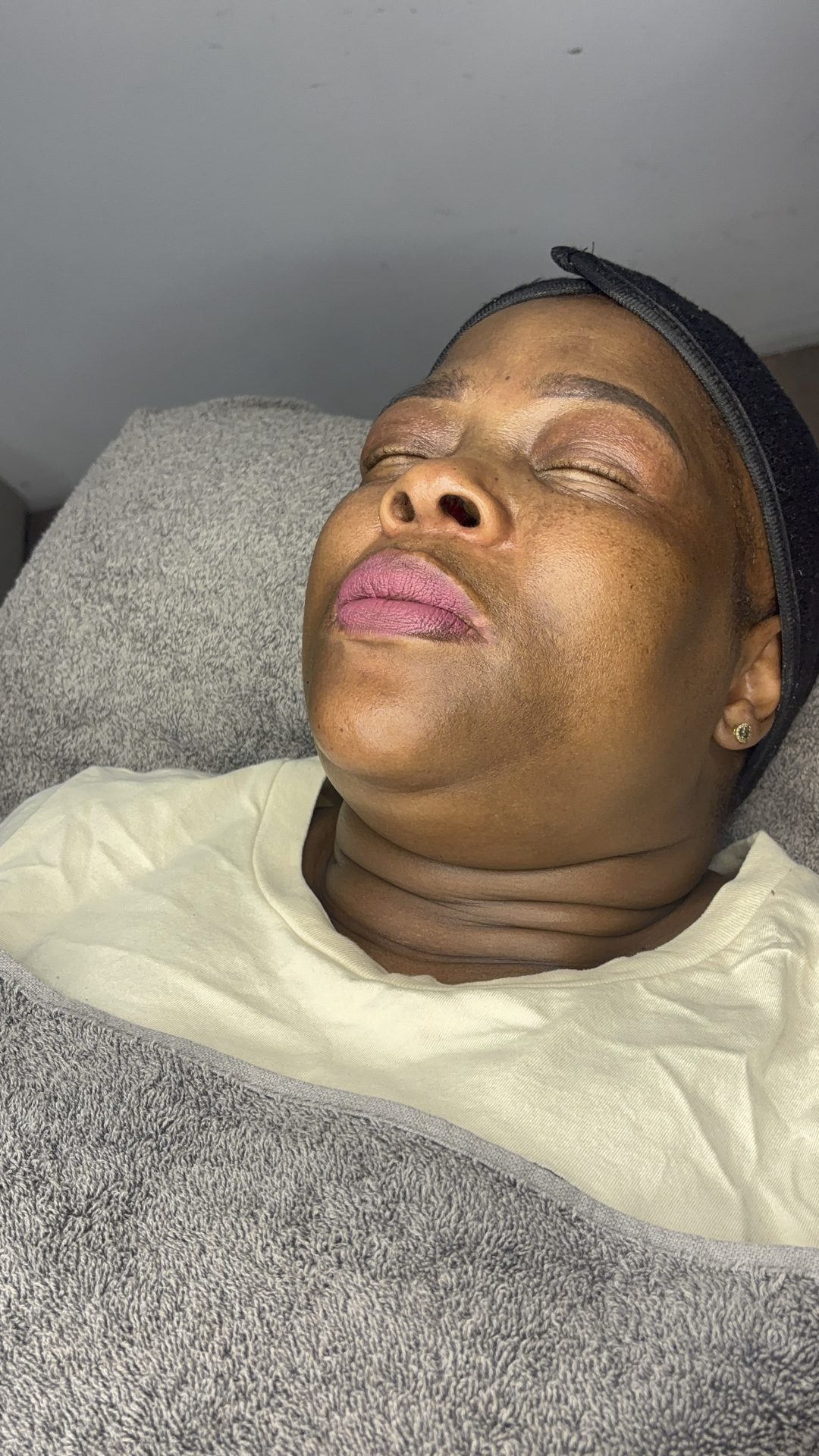 Skin treatment after result at NDI Aesthetics Kuils River