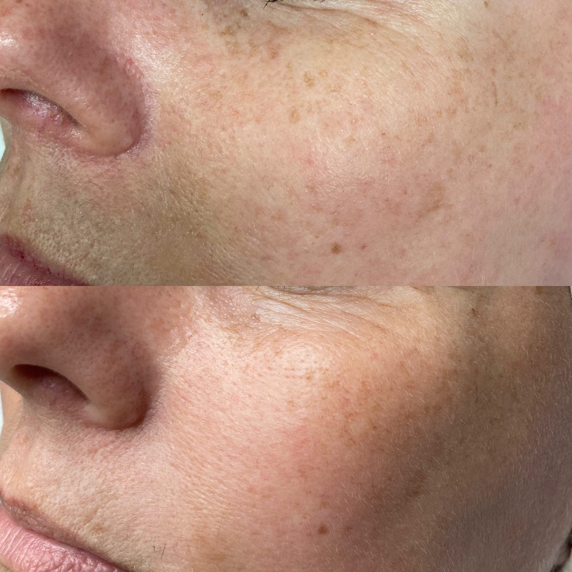 Professional skin treatment result by NDI Aesthetics Kuils River