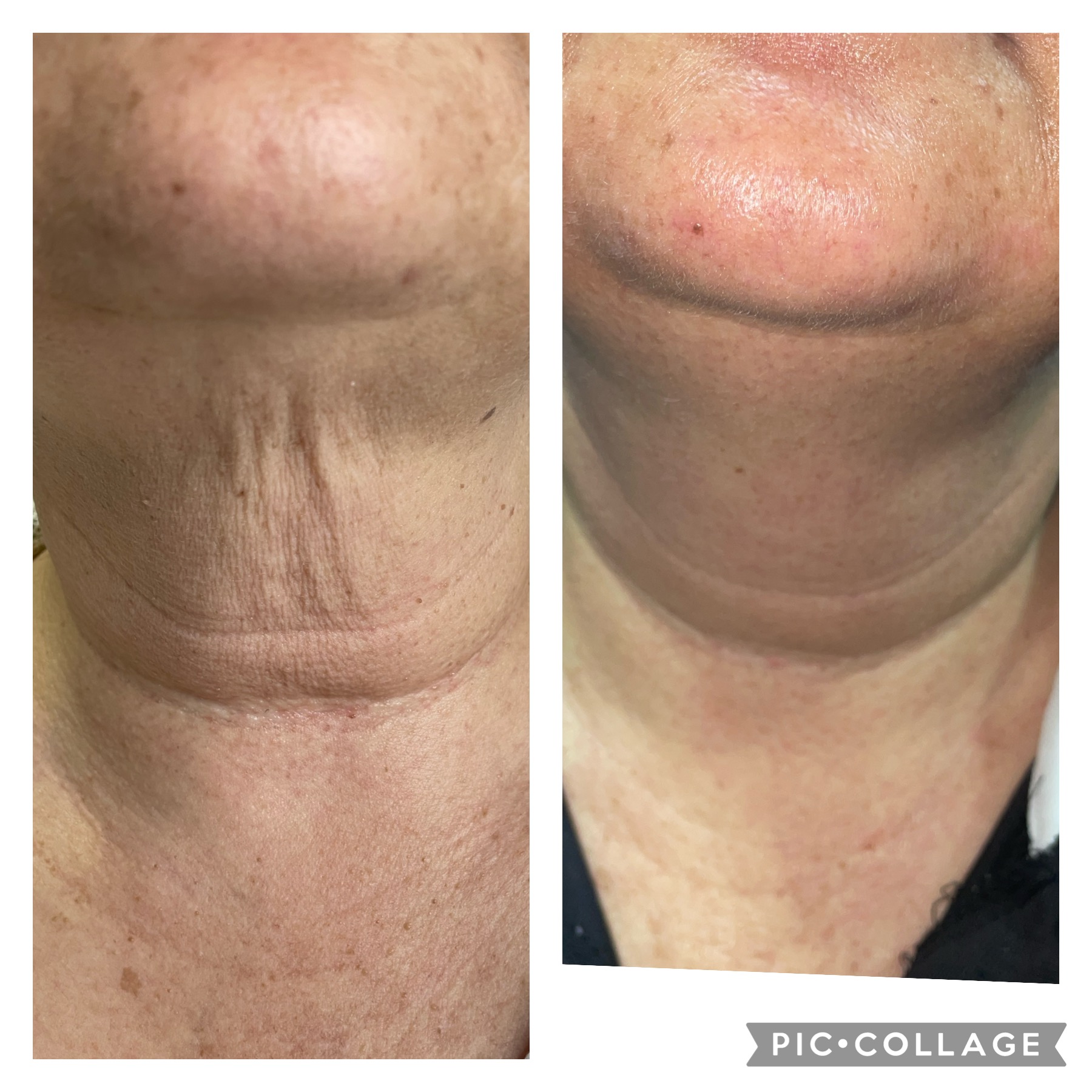 Skin rejuvenation before and after result in Cape Town