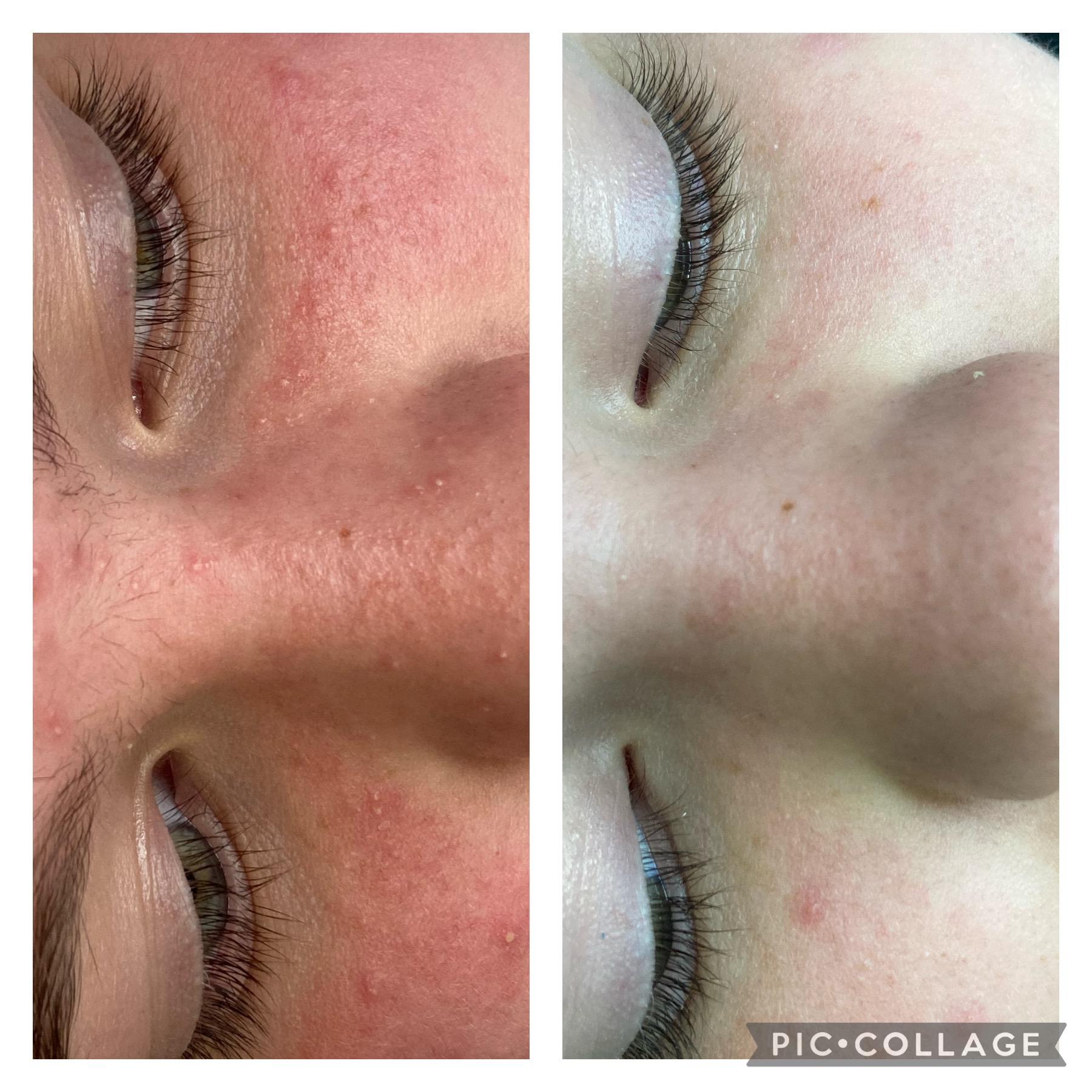 Laser treatment result by NDI Aesthetics Kuils River