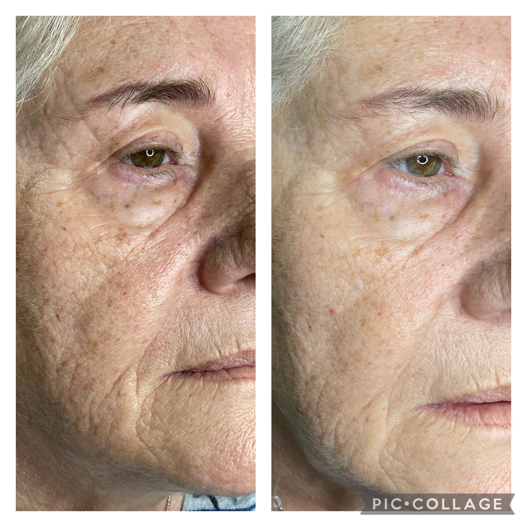 Skin texture improvement result by NDI Aesthetics Cape Town