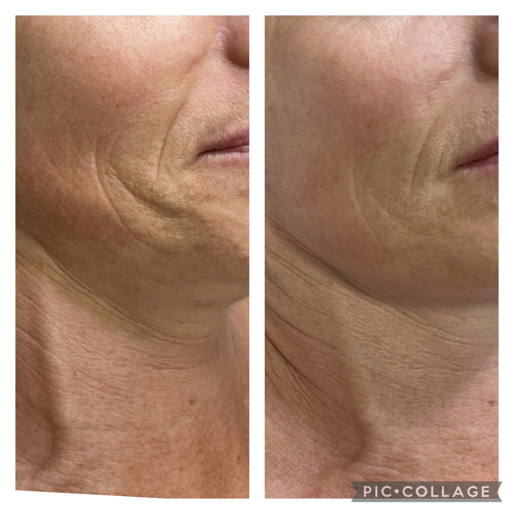 Advanced facial treatment result by NDI Aesthetics Kuils River