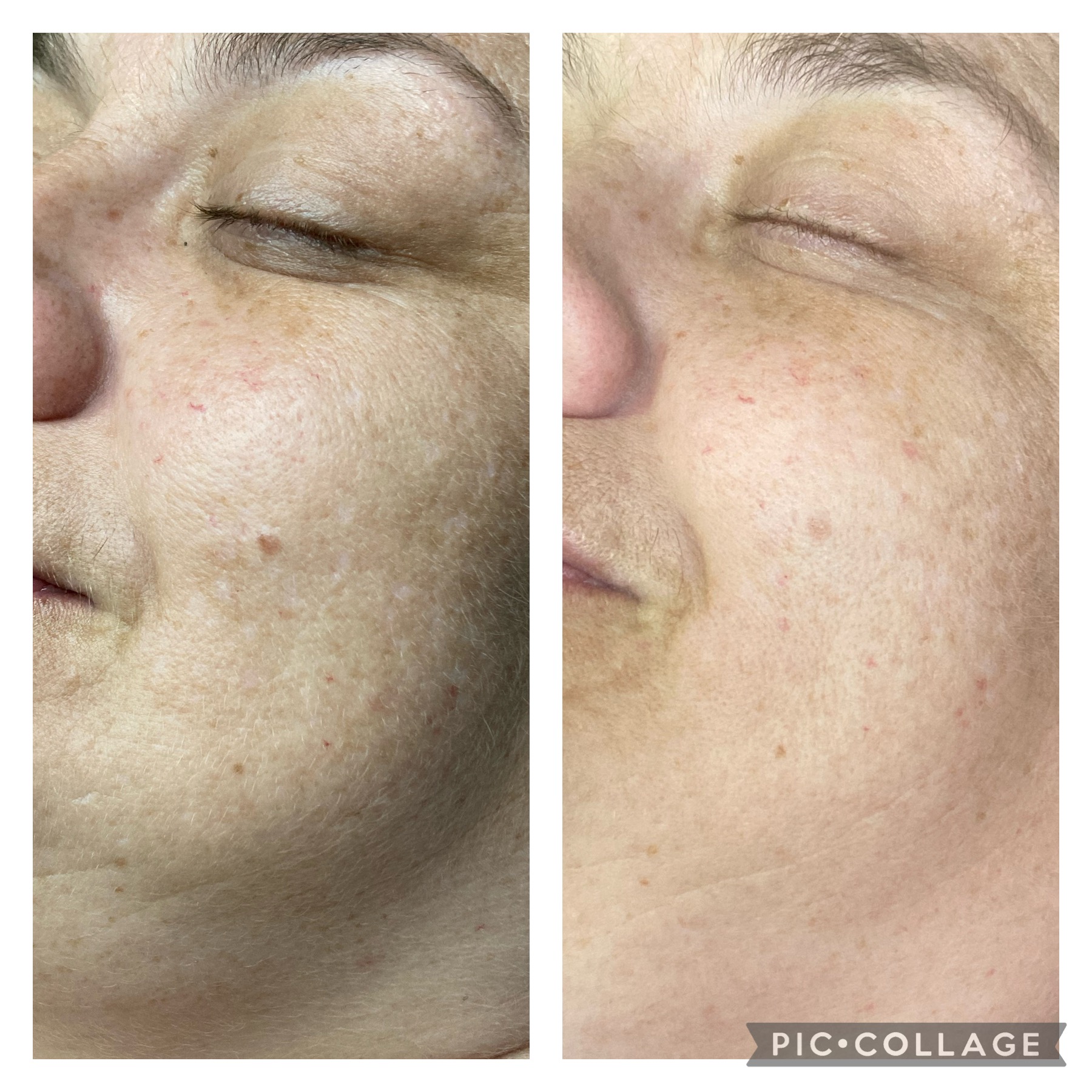Skin rejuvenation treatment result by NDI Aesthetics Cape Town