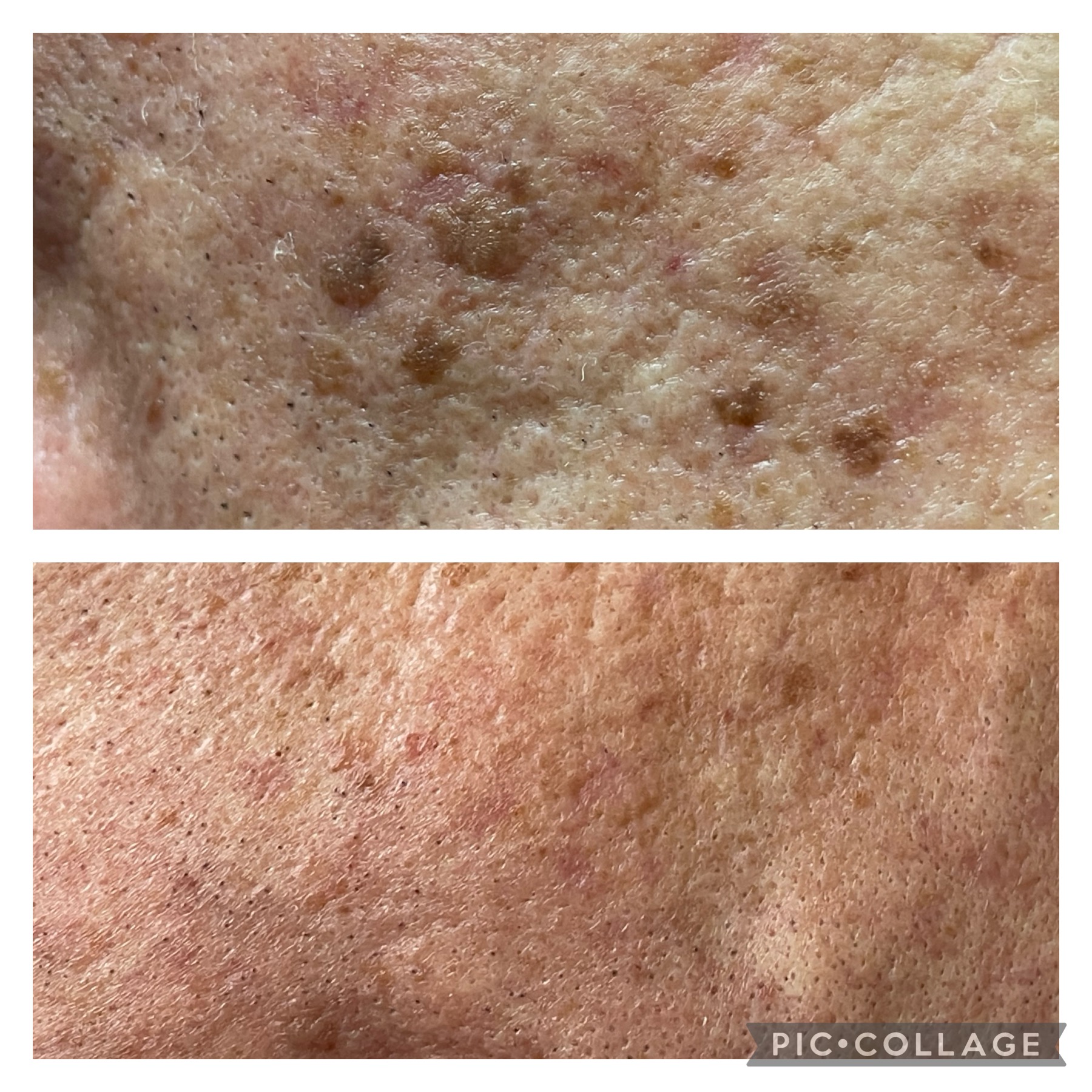 Skin pigmentation treatment result at NDI Aesthetics Kuils River