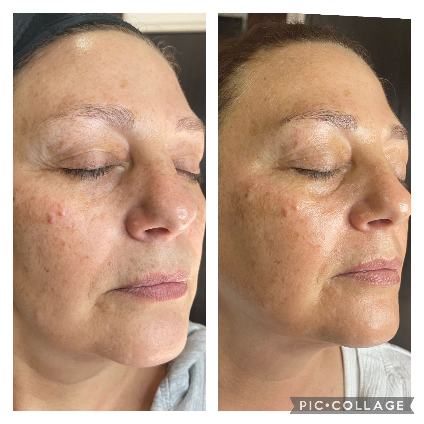 Professional aesthetic treatment result at NDI Aesthetics Cape Town