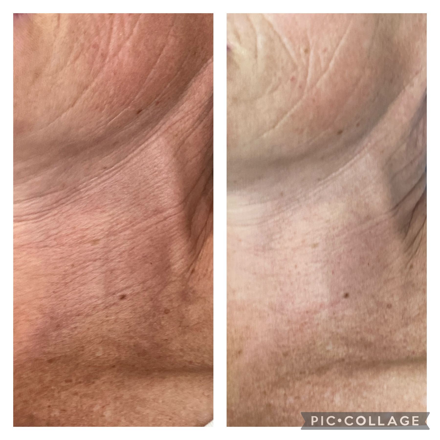 Advanced aesthetic treatment result by NDI Aesthetics Kuils River Cape Town