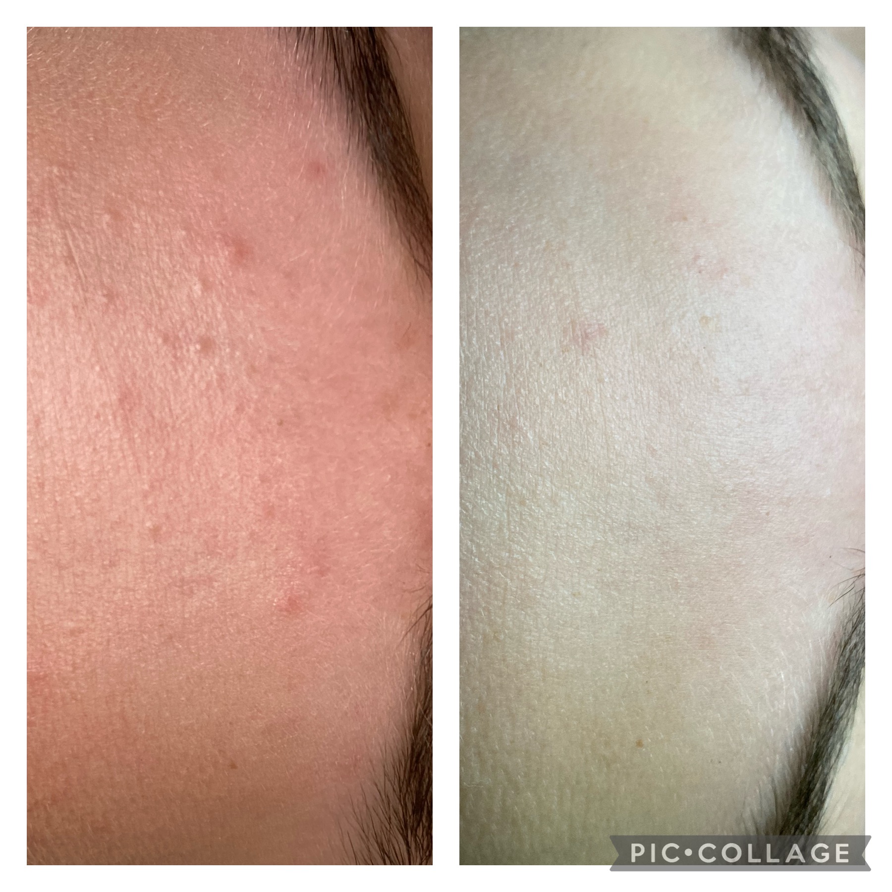Skin rejuvenation aesthetic result by NDI Aesthetics Cape Town