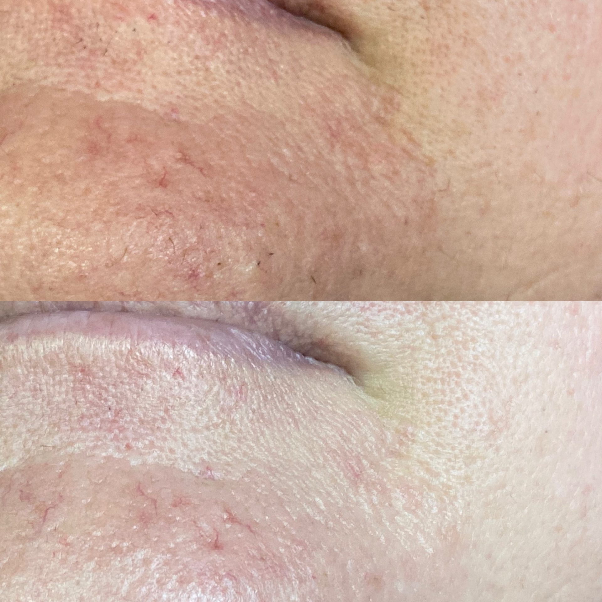 Advanced skin treatment result by NDI Aesthetics Kuils River
