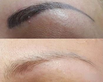 Permanent makeup brow removal treatment at NDI Aesthetics in Kuils River