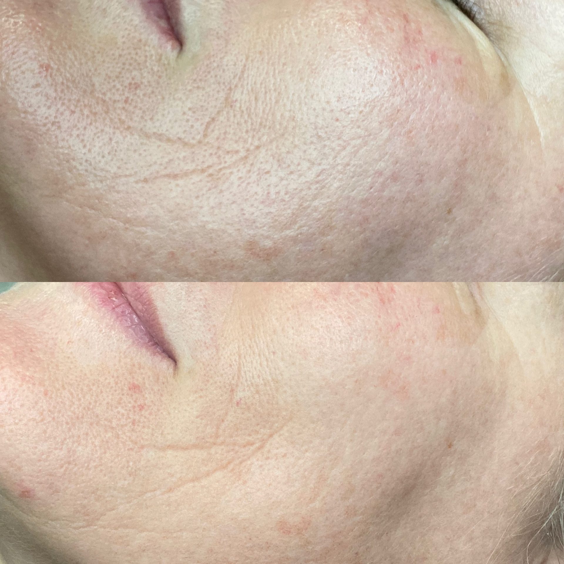 Plasma pen treatment at NDI Aesthetics in Kuils River